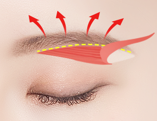 sub-brow lift korea - Sub-brow Lift